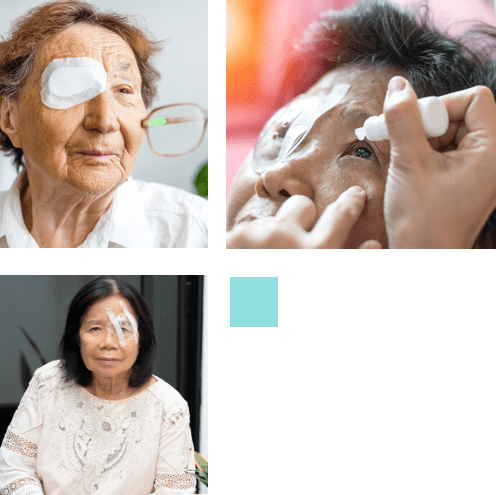 Cataract post operative care